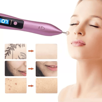 Cauterizador Lunares